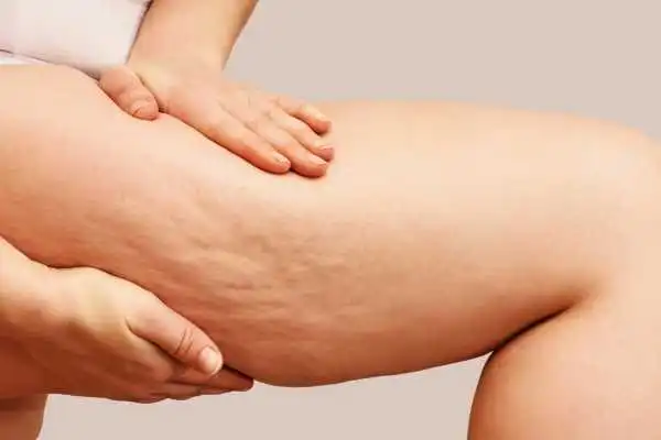 Image of woman showing leg with cellulite Ryton on Dunsmore