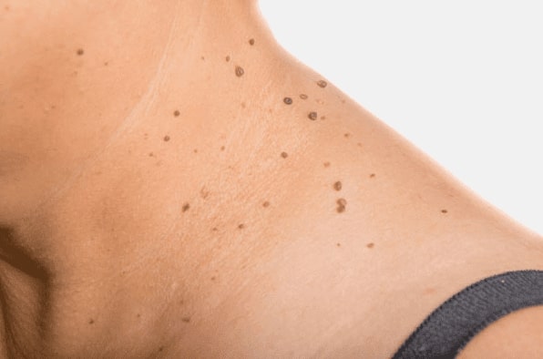 Are you looking for easy skin tag removal Ryton on Dunsmore - then contact Spire today!