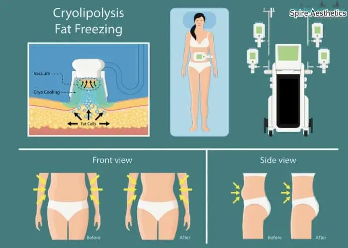 Fat freezing treatment Ryton on Dunsmore benefits for competitions to remove stubborn fat deposits.