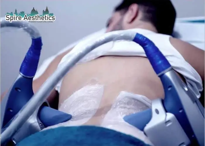 Man having fat freezing treatment done on love handles before a competitions Ryton on Dunsmore to create a sculpted look.