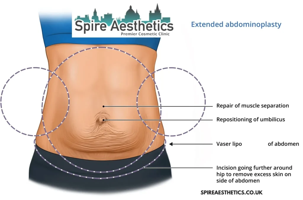 Understanding Loose Skin After Gastric Band Ryton on Dunsmore Surgery and HIFU Treatment