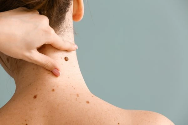 Prices and promotions for blemish removal Ryton on Dunsmore contact our team today!