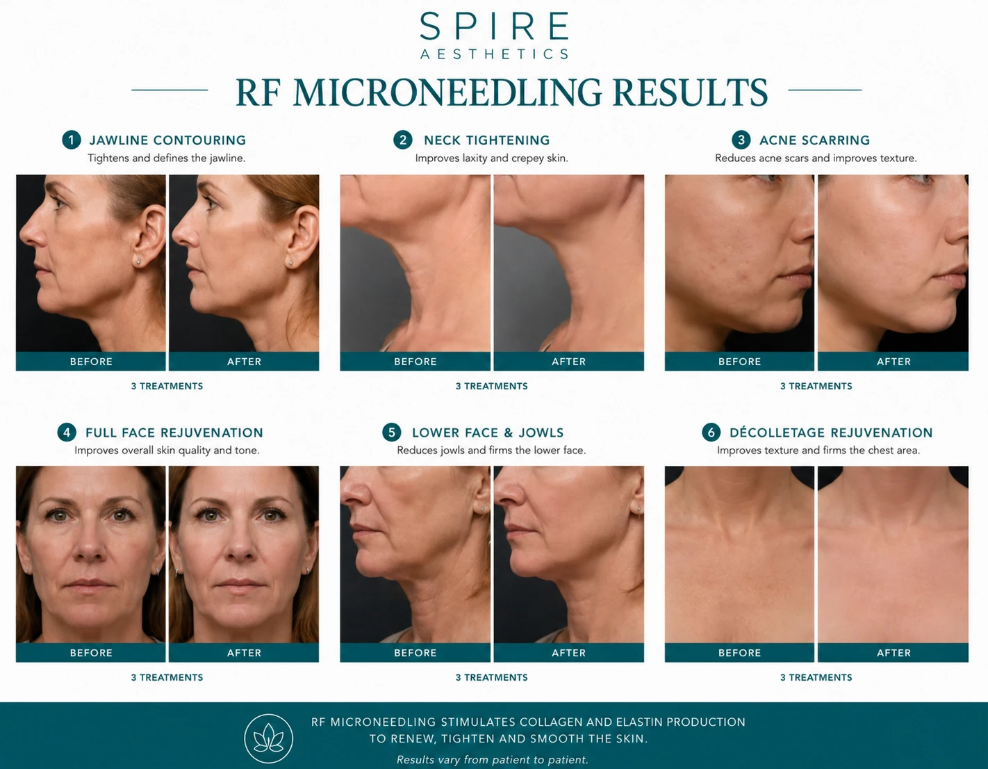 RF Microneedling Skin tightening Ryton on Dunsmore results