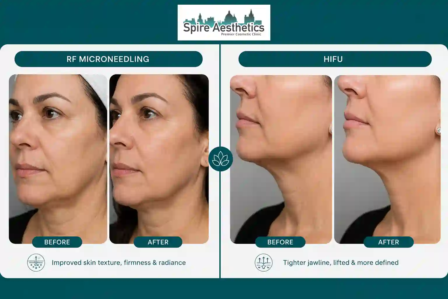 Can RF Microneedling and HIFU Be Combined Ryton on Dunsmore?